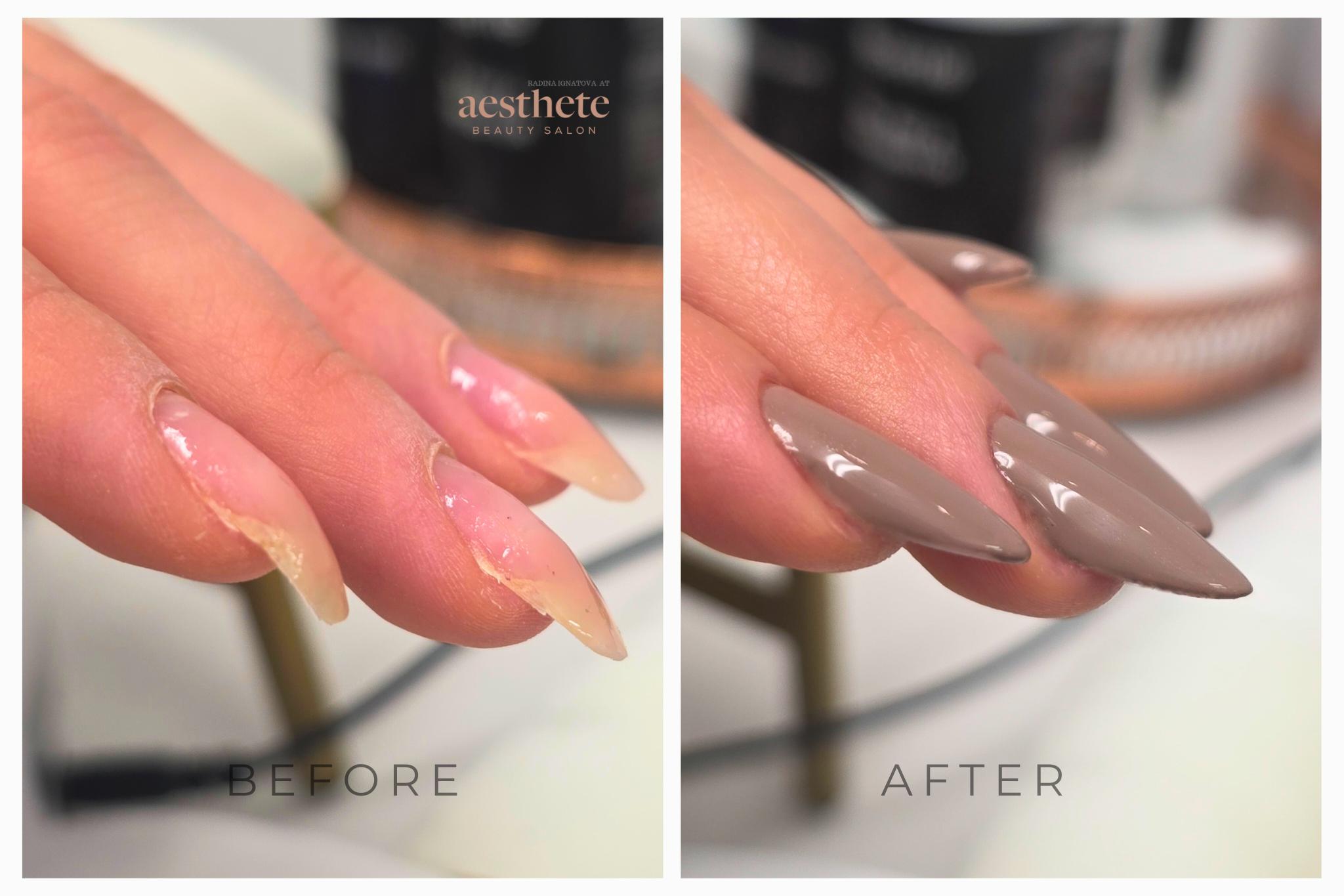 Downward-growing nails before and after structural correction showing straightened growth direction at Aesthete Beauty Dundee