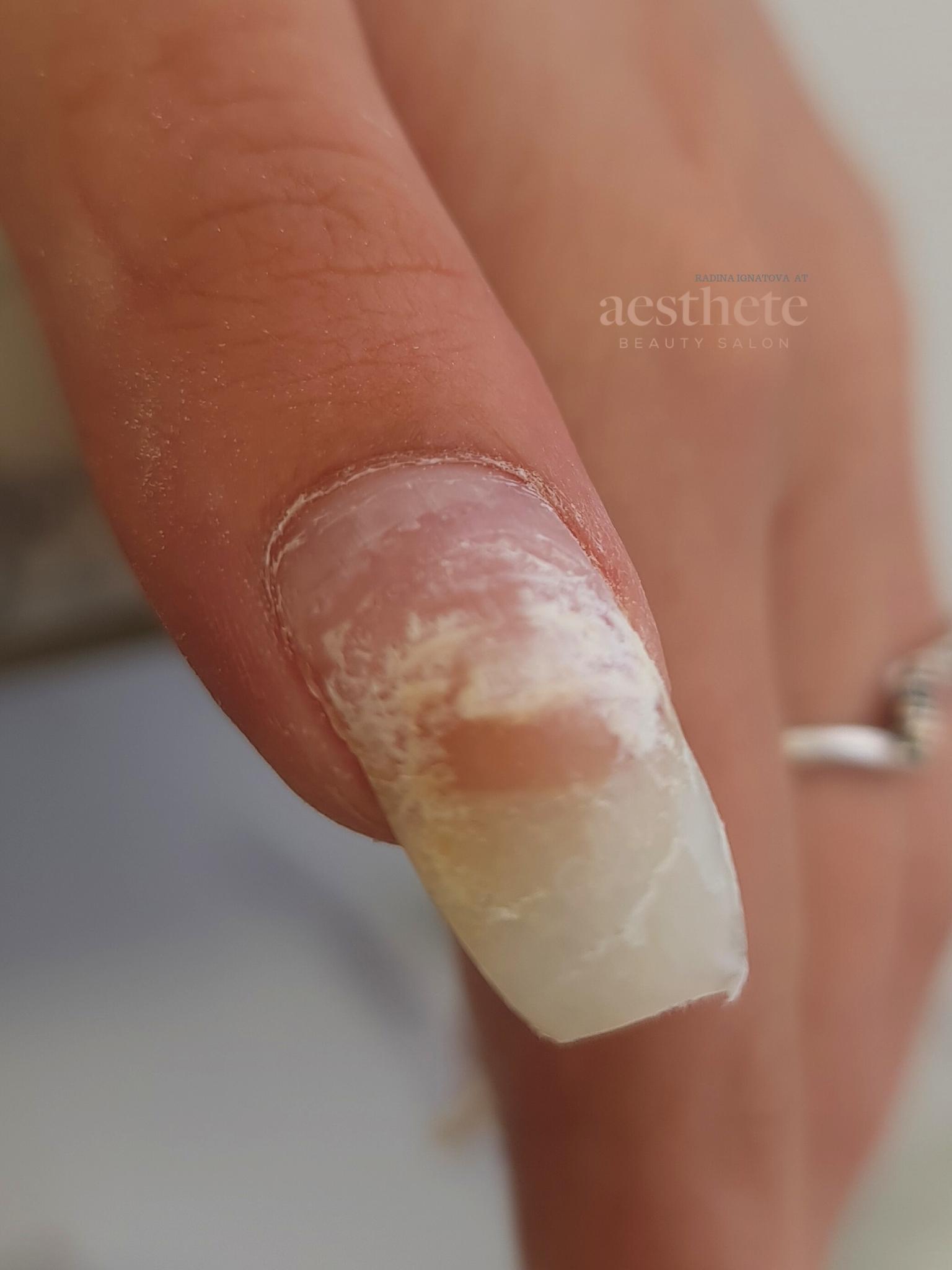 Stress zone damage on downward-growing nail showing pressure effects under BIAB overlay at Aesthete Beauty Dundee