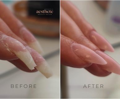 Before and after images of downward-growing hooked nails corrected at Aesthete Beauty, showing the free edge lifted and the nail structure rebuilt.